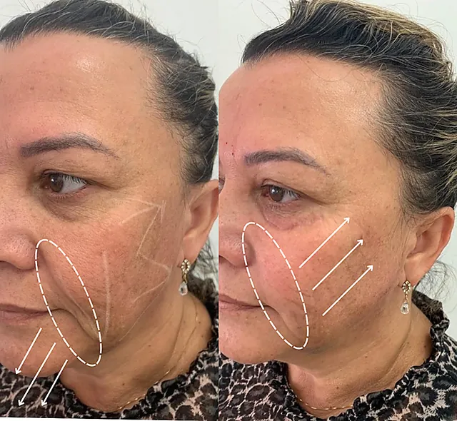 Antes e depois da mesma paciente. À esquerda, setas apontam para baixo indicando a perda de firmeza; à direita, apontam para cima, no sentido da sustentação recuperada.