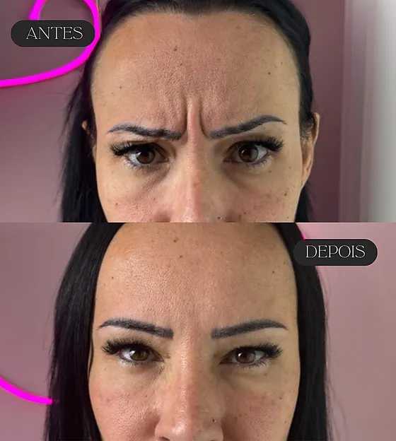 Antes e depois de botox no vinco entre as sobrancelhas, com a testa em contração.