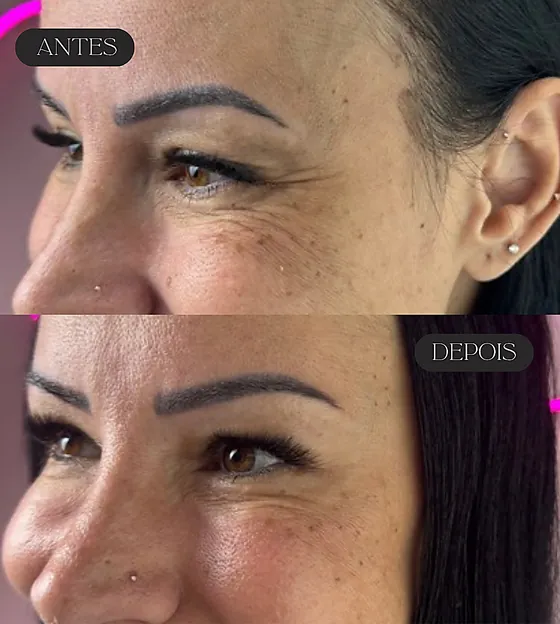 Antes e depois de aplicação de botox na região dos olhos.