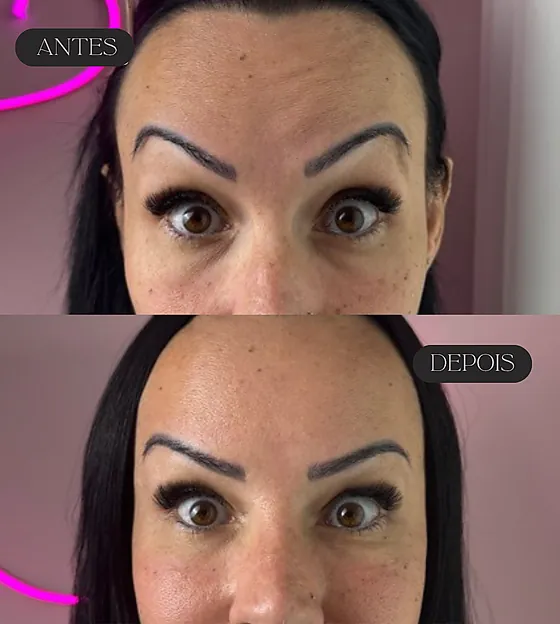 Antes e depois de botox nas linhas horizontais da testa.