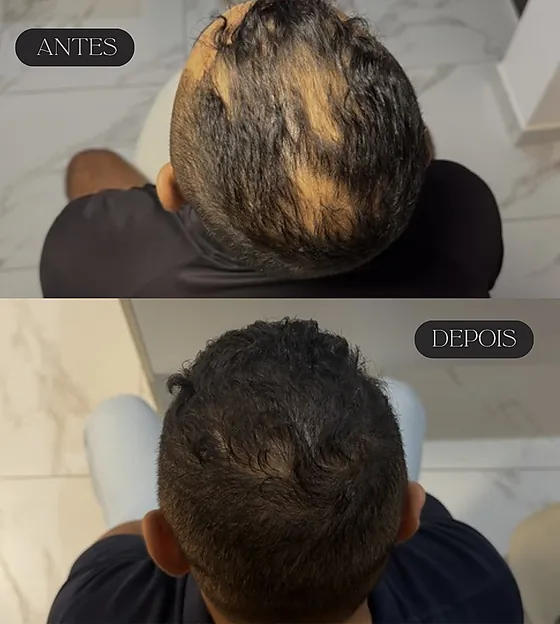 Antes e depois de tratamento capilar, vista do topo da cabeça.