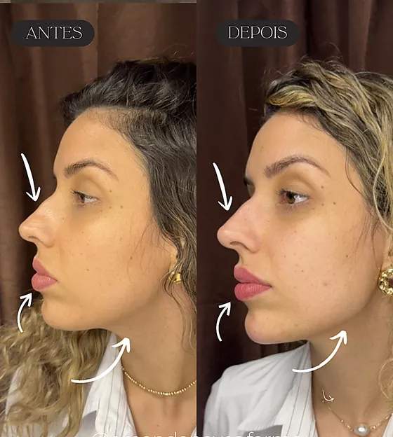 Antes e depois de preenchimento em nariz, lábios, queixo e mandíbula, vista de perfil.