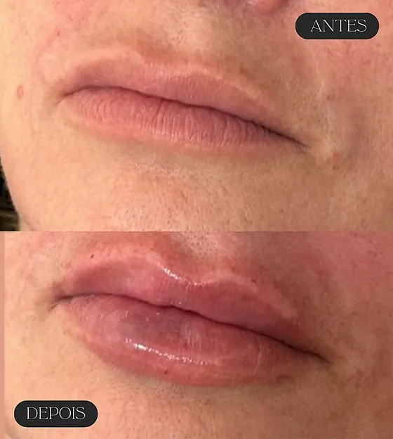 Antes e depois de preenchimento labial, em close.