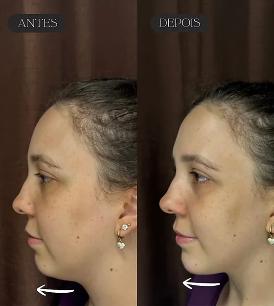 Antes e depois de preenchimento de queixo em paciente madura, vista de perfil.