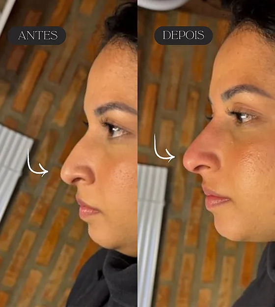 Antes e depois de rinomodelação, vista de perfil.